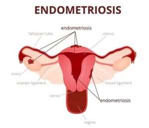 endo belly bloating endo belly bloating