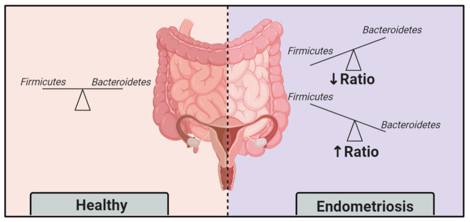 Endometriosis and Gut Health