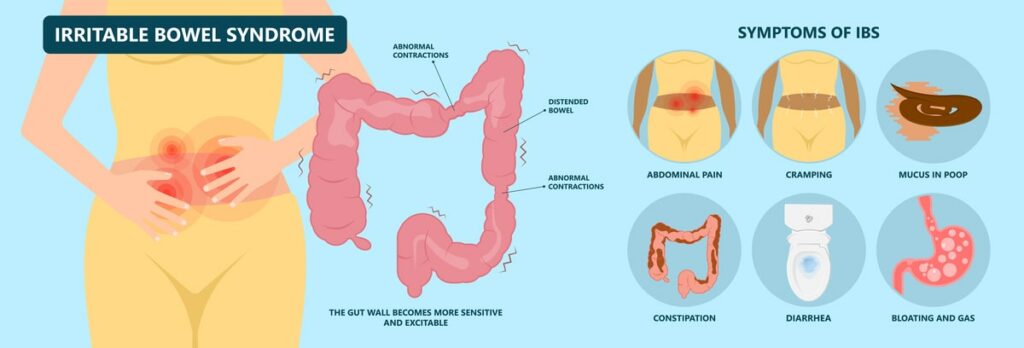 IBS Bloating and Stomach Distension: How to Find Relief