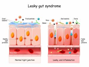 Alcohol and IBS: Does Drinking Make IBS Worse?