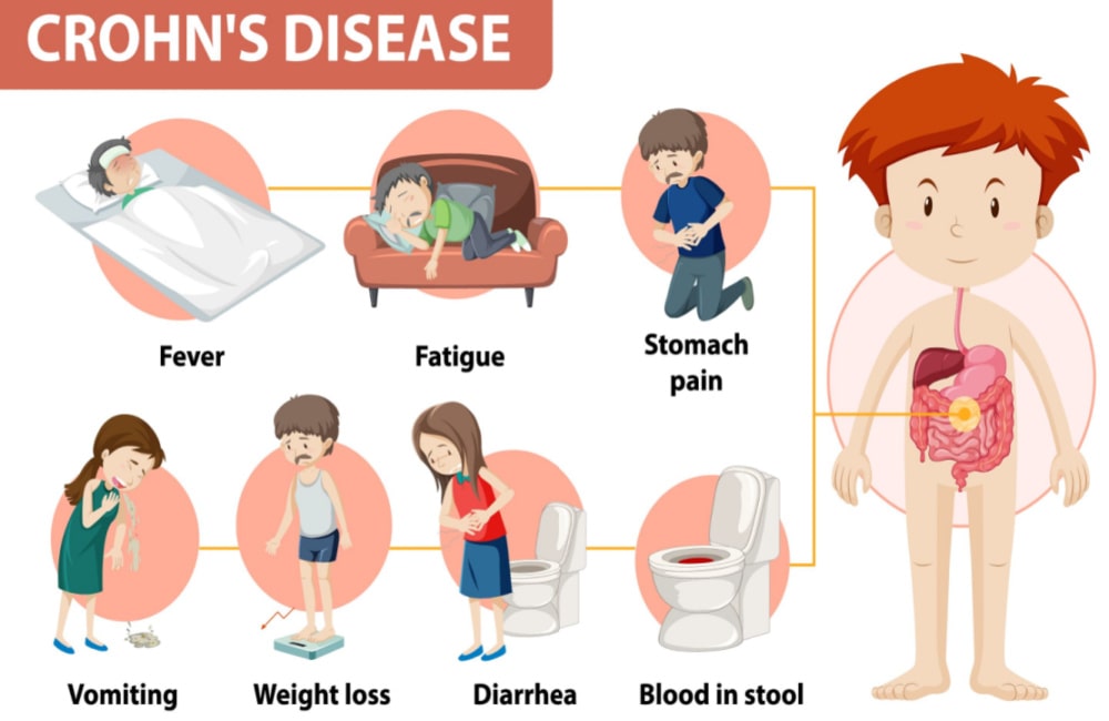 What Is Crohn's Disease