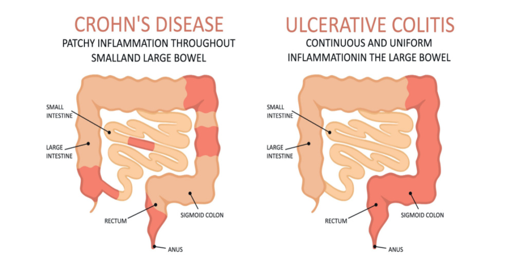 Inflammatory Bowel Disease Ibd Symptoms And Causes 6870