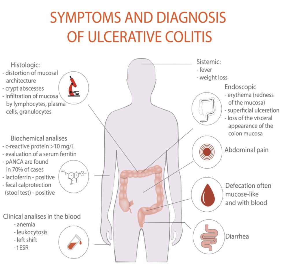 What is Ulcerative Colitis, What causes ulcerative colitis