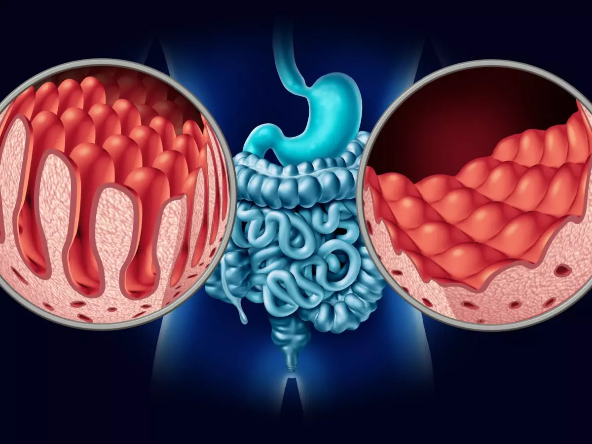 Coeliac Disease
