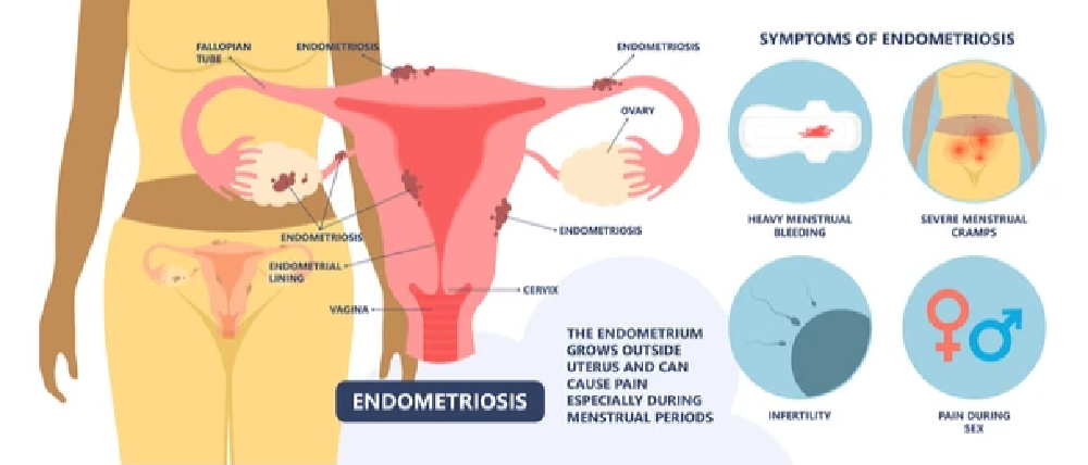 How Is Endometriosis Diagnosed The IBS Gut Health Clinic