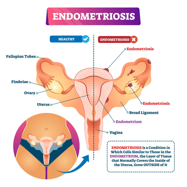 Endometriosis