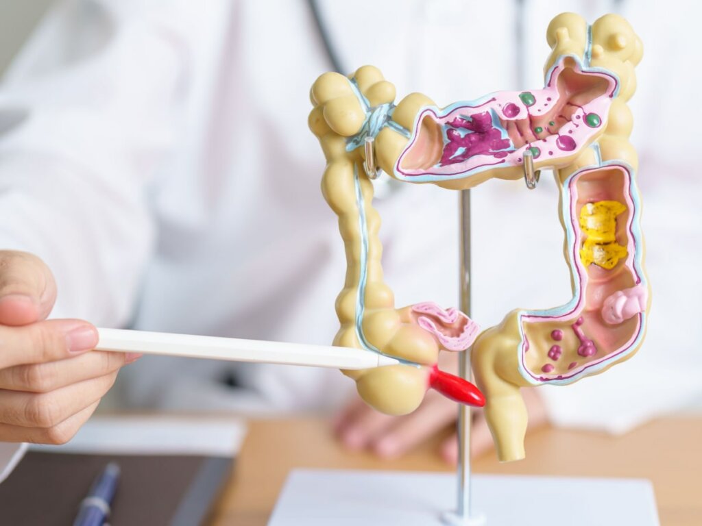 What is Diverticulitis? The IBS & Gut Health Clinic