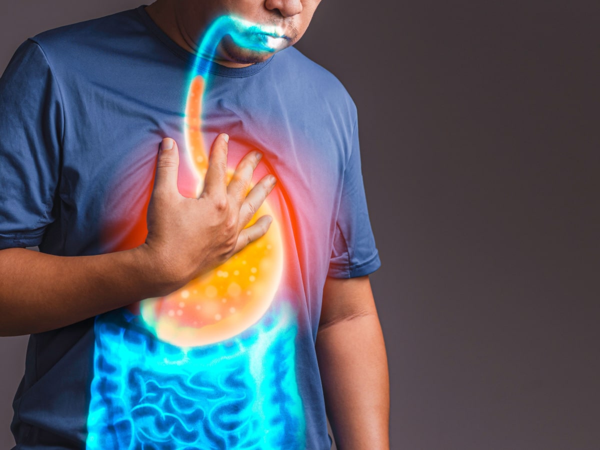 Can SIBO Cause Acid Reflux