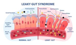 What is Leaky Gut and do you Have It? | The IBS & Gut Health Clinic