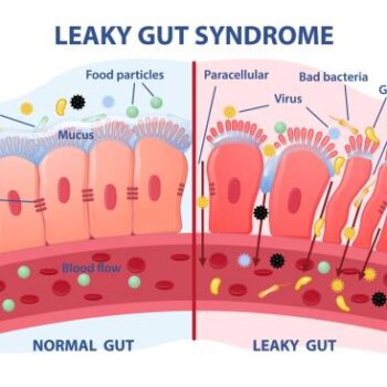 What is Leaky Gut and do you Have It? | The IBS & Gut Health Clinic